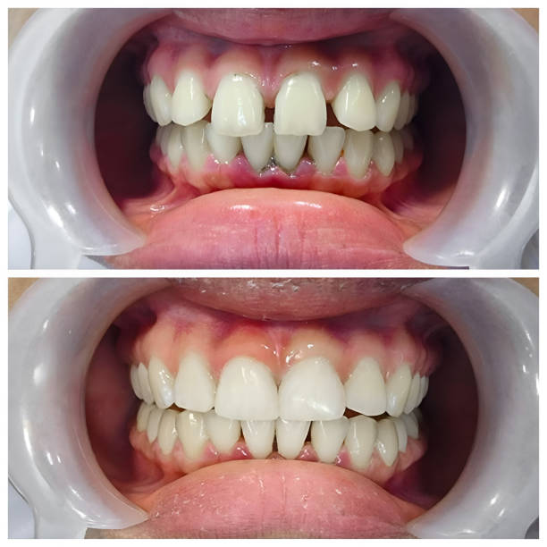 Full Mouth Reconstruction in San Antonio Heights, CA